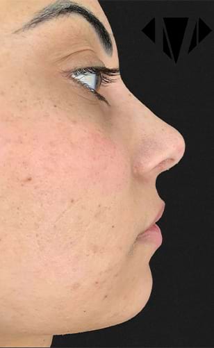 Antes e Depois de Tratamento Facial