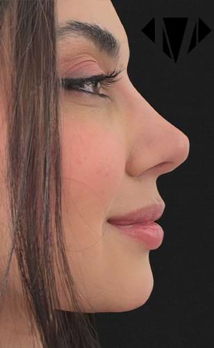 Resultado de Harmonização Facial em Balneário Piçarras